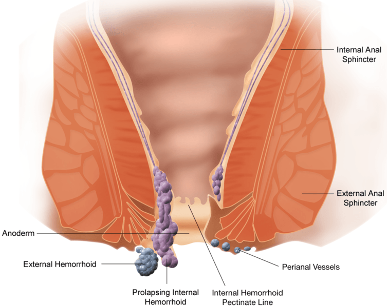 Wondering if can hemorrhoids have an odor? Find out the common causes and simple relief tips.