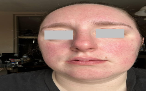 Is Korean skincare for rosacea a good choice? Discover the best options for your easily irritated skin.