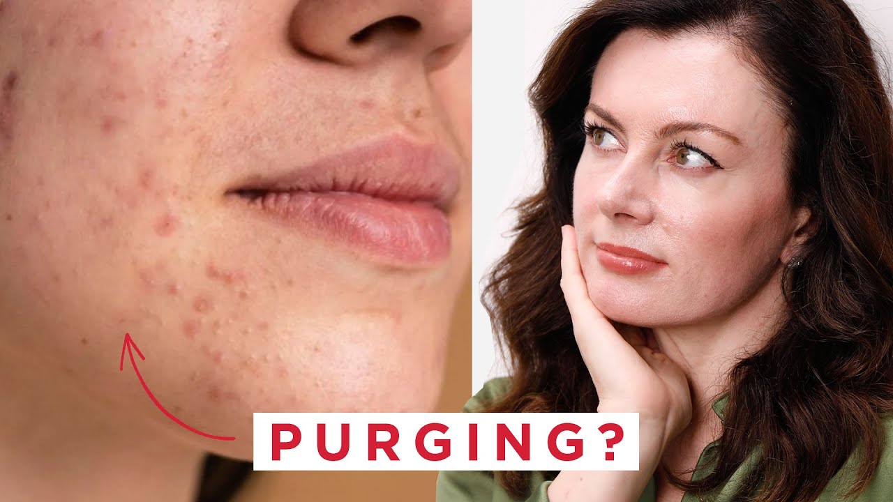 Does azelaic acid cause purging? Find out how long this skin clearing process might last.