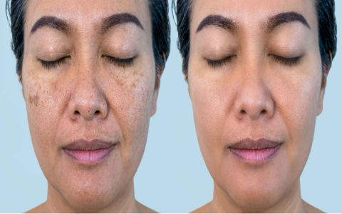 What natural oils for hyperpigmentation actually work? (Easy tips for fading those dark spots fast!)