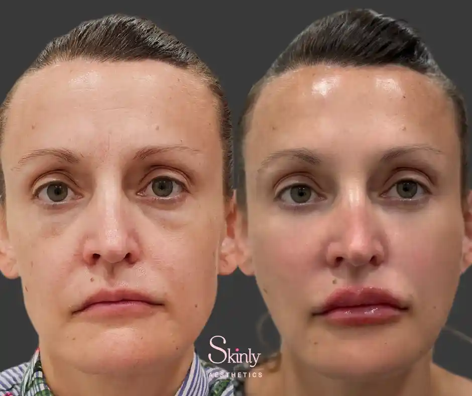 Liquid Facelift: Get great results! This amazing treatment gives a quick and youthful appearance.