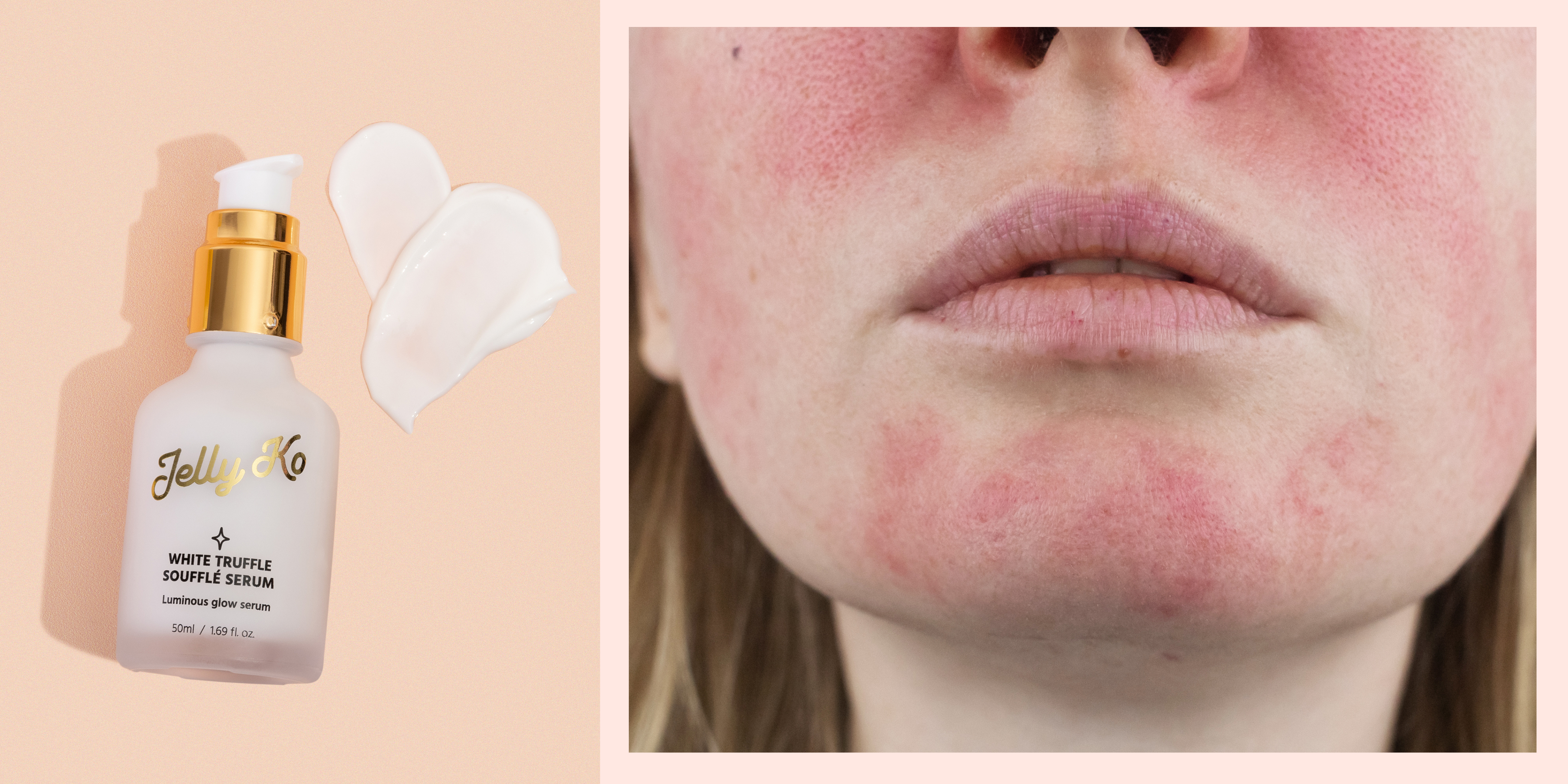 Is Korean skincare for rosacea a good choice? Discover the best options for your easily irritated skin.