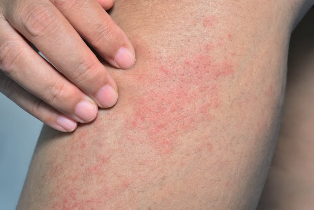 Is it true, does pool chlorine kill fungus on skin? What experts say about treating skin problems this way.