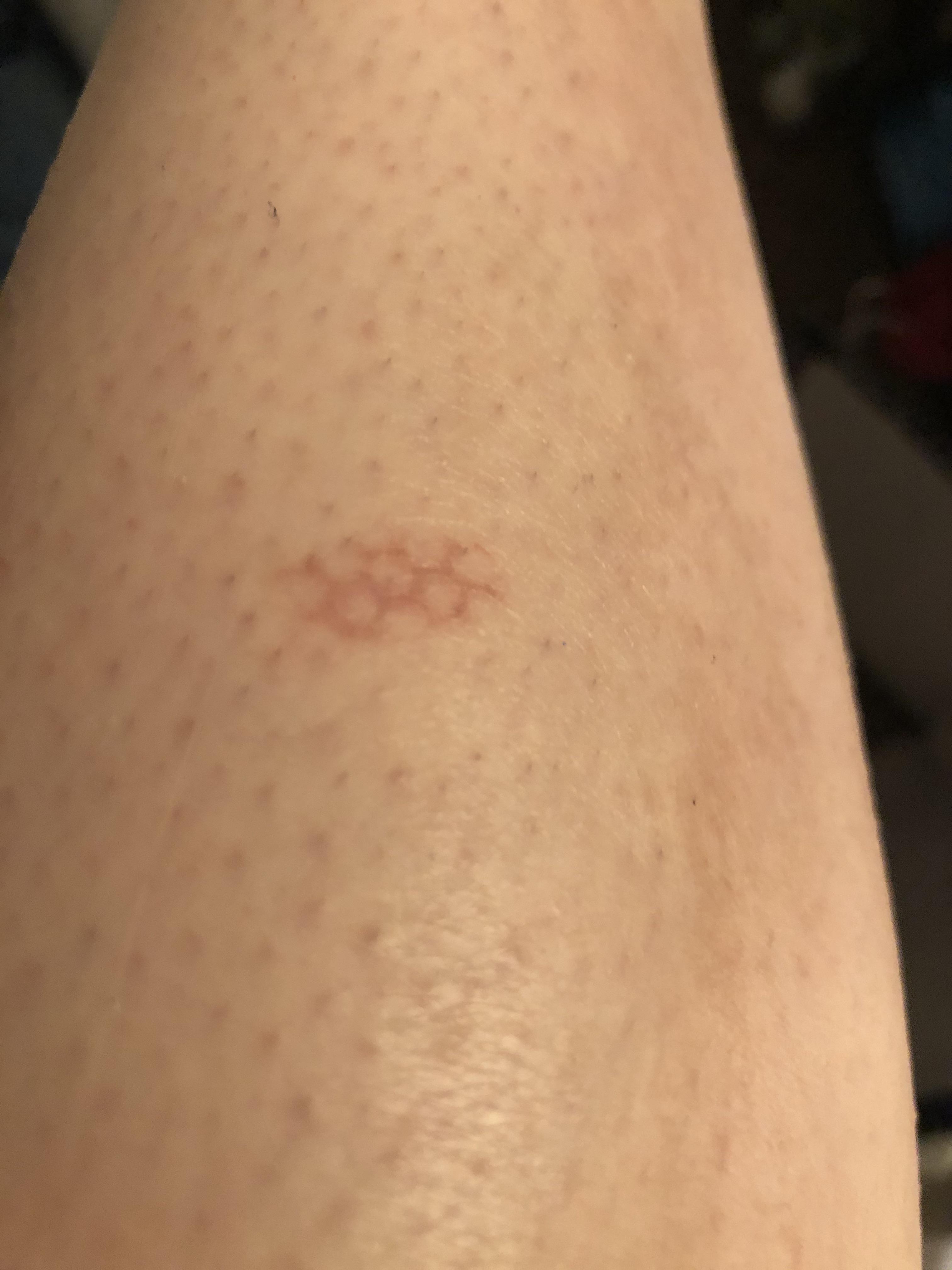 Is skin honeycomb a dangerous condition to have? Discover quick and easy ways to help clear up your skin fast.