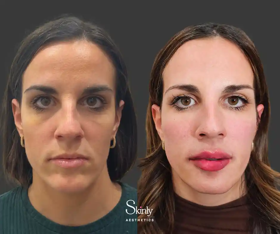 Liquid Facelift: Get great results! This amazing treatment gives a quick and youthful appearance.