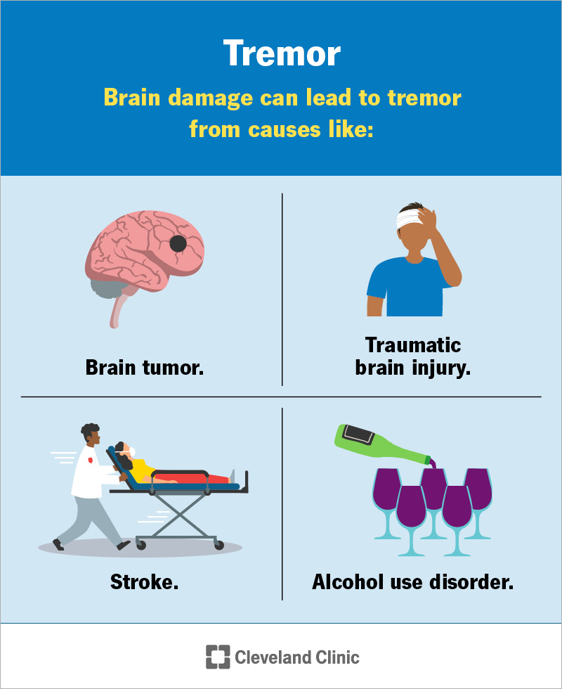 Somatic tremor explained simply: How to easily spot signs and deal with your body shaking!