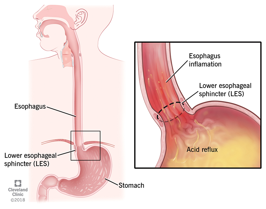 Can GERD Cause Stomach Bloating? Discover the Hidden Link and How to Stop It Now