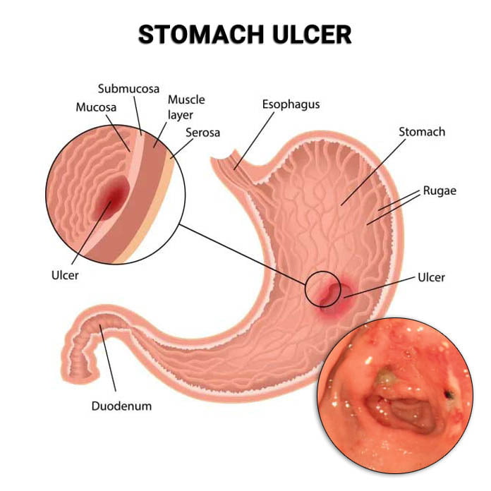 Do Stomach Ulcers Cause Bloating? Uncover the Surprising Truth and How to Find Relief Fast