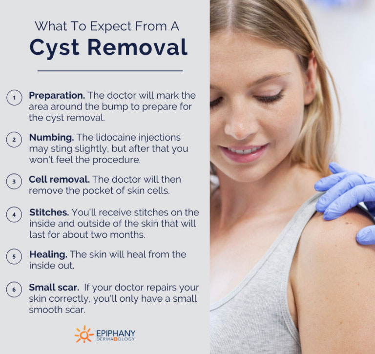 Will a cyst inside shoulder go away? Find out if it can resolve on its own and what you can do about it.