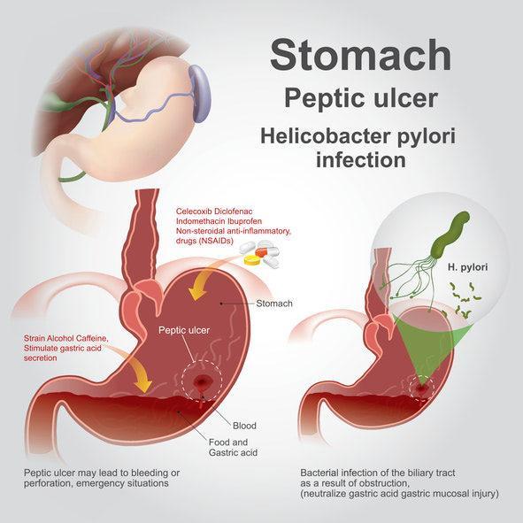 Do Stomach Ulcers Cause Bloating? Uncover the Surprising Truth and How to Find Relief Fast