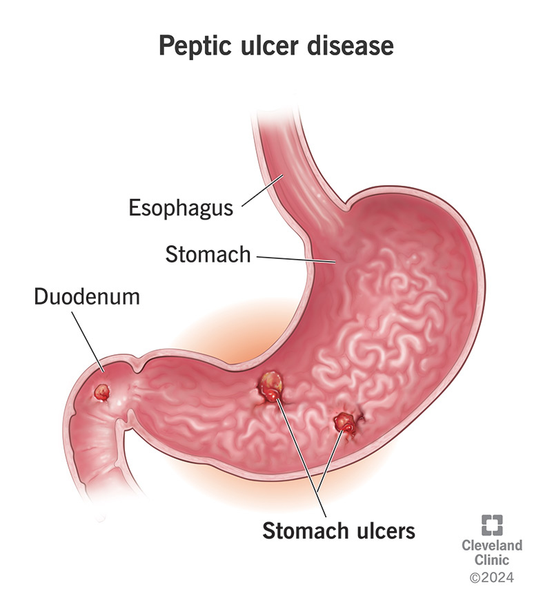 Do Stomach Ulcers Cause Bloating? Uncover the Surprising Truth and How to Find Relief Fast