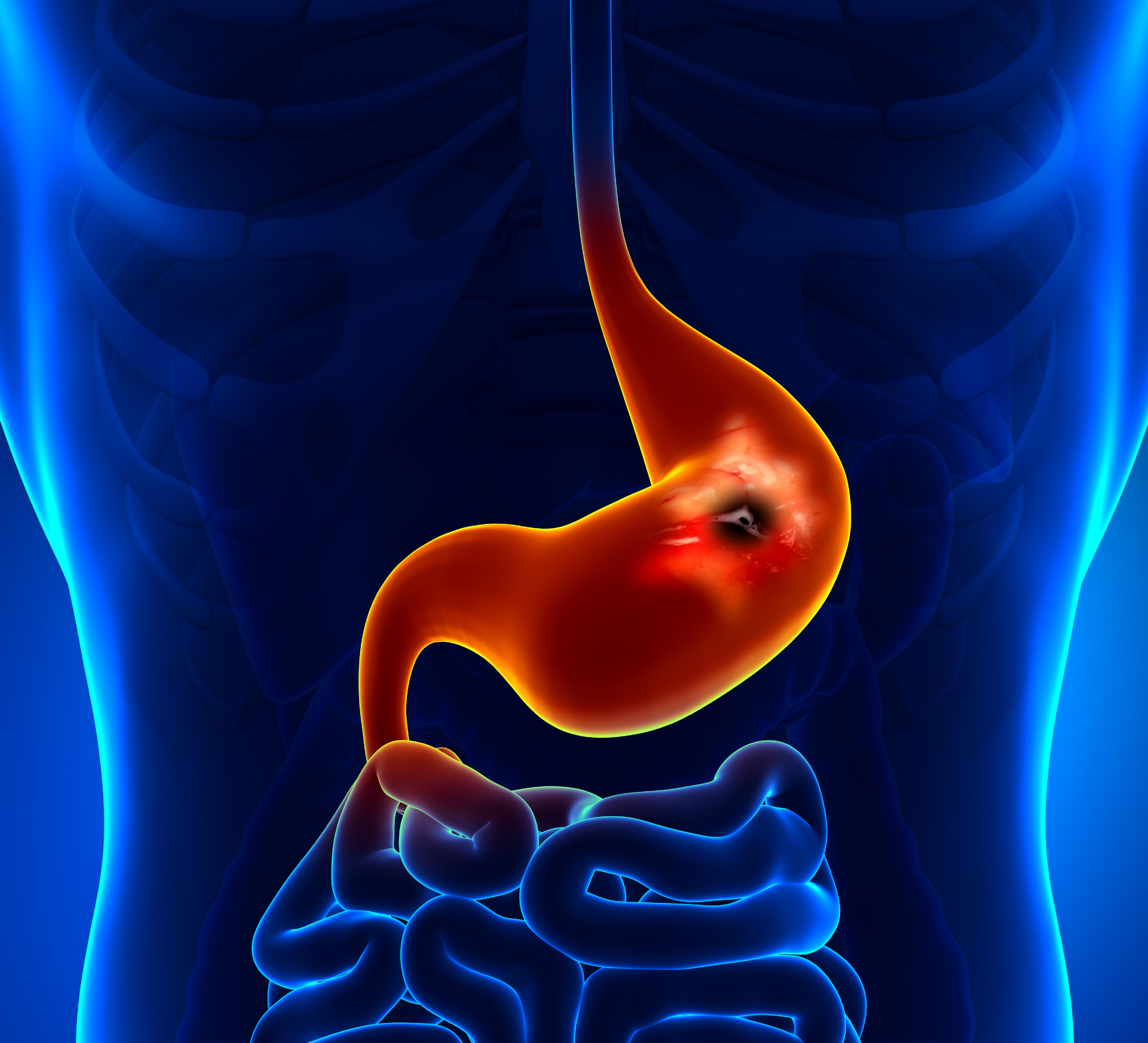 Do Stomach Ulcers Cause Bloating? Uncover the Surprising Truth and How to Find Relief Fast