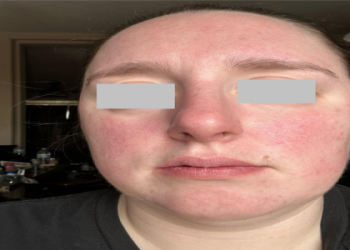 Is Korean skincare for rosacea a good choice? Discover the best options for your easily irritated skin.