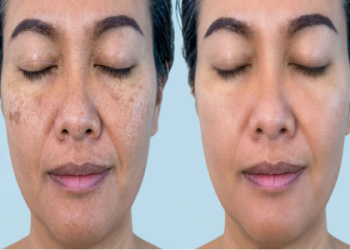 What natural oils for hyperpigmentation actually work? (Easy tips for fading those dark spots fast!)