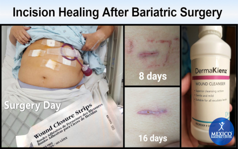 Can you have sex after surgery? Find out crucial recovery details you need before you decide.