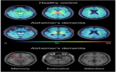 Is it true can levodopa help with meth drug addiction? Learn more about this potential treatment option today.